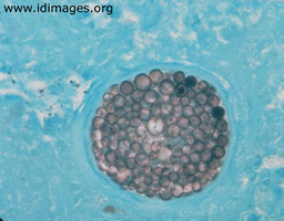 Figure 1.  <i>Coccidioides immitis</i>, GMS stain of a  lung biopsy.