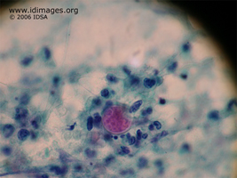 Figure 3.  <i>Coccidioides</i> seen by H and E stain  of biopsy.