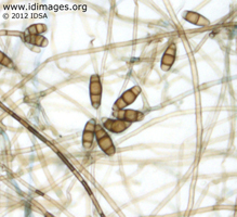 Figure 1.  Wet mount microscopy with multicellular  conidia of Curvularia.