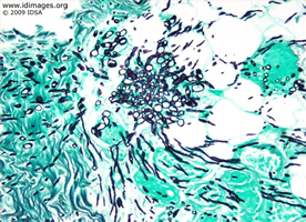 Figure 3.  Fusarium on skin biopsy, Giemsa stain.