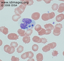 Figure 1.   Wright stain showing <i>Histoplasma capsulatum</i>.