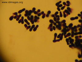 Figure 1.  Gram stain of <i> Malassezia furfur</i>.