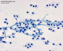 Figure 2.  <i>Scedosporium apiospermum</i>, with  hyphae and terminal annelloconidia.