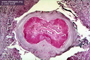 Figure 1.  <i>Dirofilaria immitis</i> seen by hematoxylin and   eosin stain of a resected lung nodule.