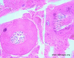 Figure 3.  Resected pelvic mass showing scolices consistent with <i>Echinococcus granulosus</i>.