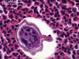 Figure 1.  Ovum of <i>Schistosoma mansoni</i> with lateral  spine, seen on biopsy of cerebellar lesion.