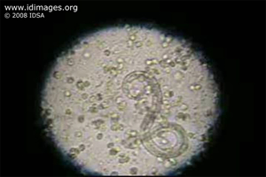 Figure 2.  Wet mount of tracheal aspirate showing  <em>Strongyloides stercoralis</em>.