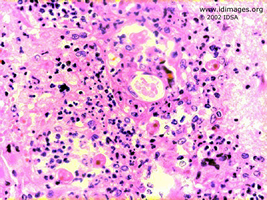 Figure 1.  <i>Acanthamoeba castellanii</i> on  hematoxylin and eosin stain of brain biopsy.