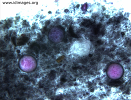 Figure 2.  <i>Entamoeba coli</i> cysts in fecal sample.