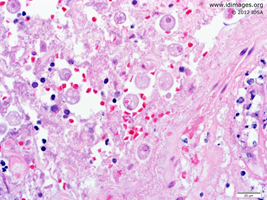 Figure 3.  <i>Entamoeba histolytica</i> on hematoxylin and eosin stain of resected colon, high power.