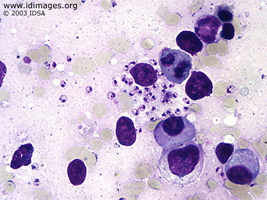 Figure 2.  Bone marrow biopsy with <i>Leishmania  donovani</i>