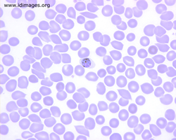 Figure 3.  <i>Plasmodium vivax</i> on thin blood smear.