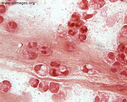 Figure 2.  <i>Bordetella pertussis</i> seen in gram stain of sputum specimen.