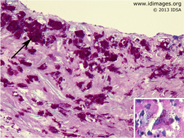 Figure 1.  <i>Tropheryma whipplei</i> shown by periodic acid-Schiff (PAS) staining of a mitral valve.