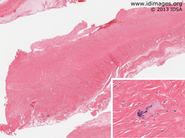 Figure 2.  <i>T. whipplei</i> shown with hematoxylin and eosin staining of thickened pericardium.